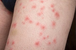 Skin irritation due to bedbugs bites 